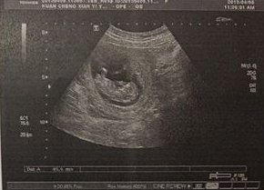 b超单看胎儿性别——从B超单胎儿形状上看胎