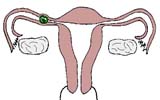 宫外孕早期症状