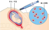 羊水穿刺