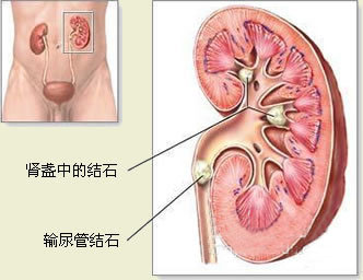 如何治疗肾结石 有哪些治疗方法