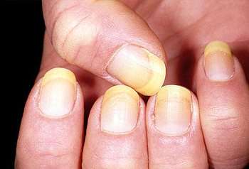 灰指甲传染吗？灰指甲怎么传染的？