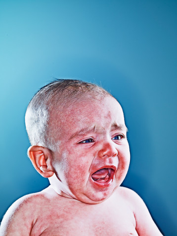 婴儿湿疹的原因 如何调理