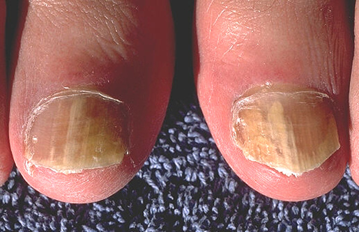 真菌性皮肤疾病：什么是灰指甲