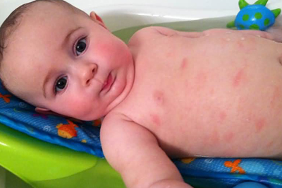 宝宝湿疹要怎么样护理？